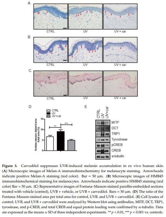 Carvedilol suppresses UVR-induced melanin accumulation in ex vivo human skin